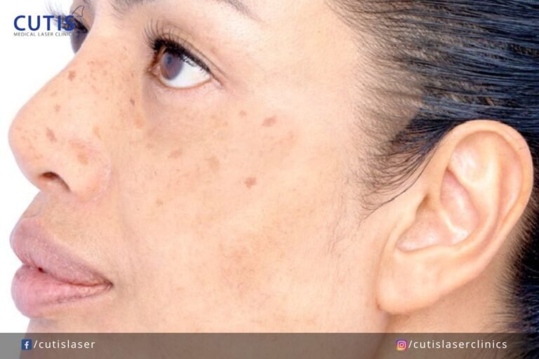 Why Your Pigmentation Treatment Doesn’t Work