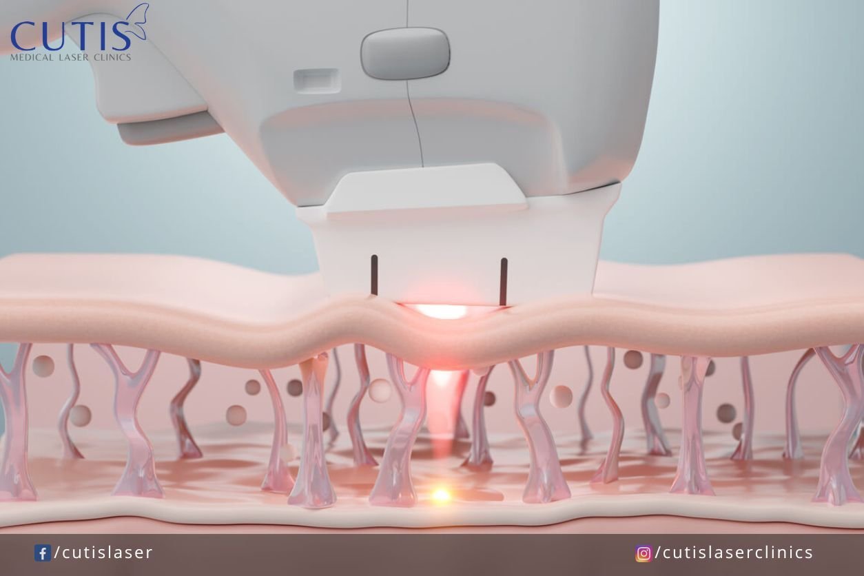 What does Ultherapy feel like