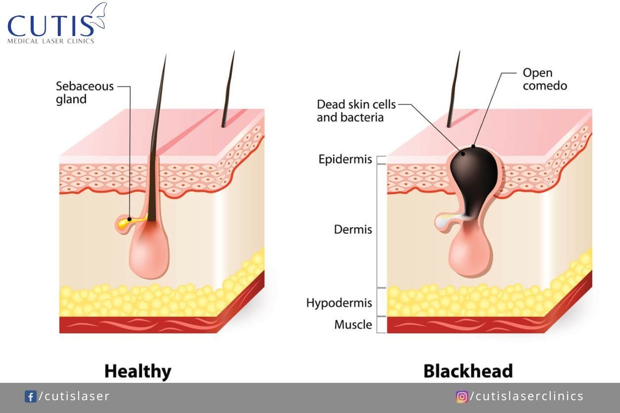 Sebaceous filaments vs blackheadsacne