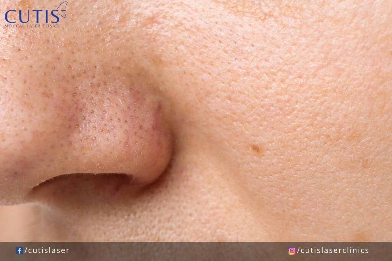 Why are some sebaceous filaments more visible