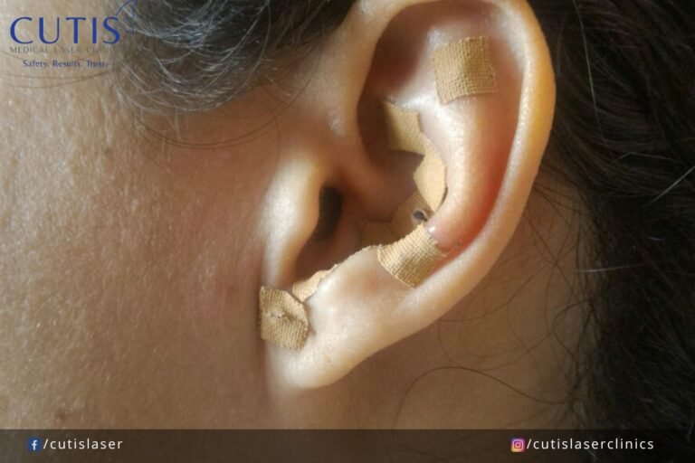 Does Ear Seeding Really Work for Facial Contouring?