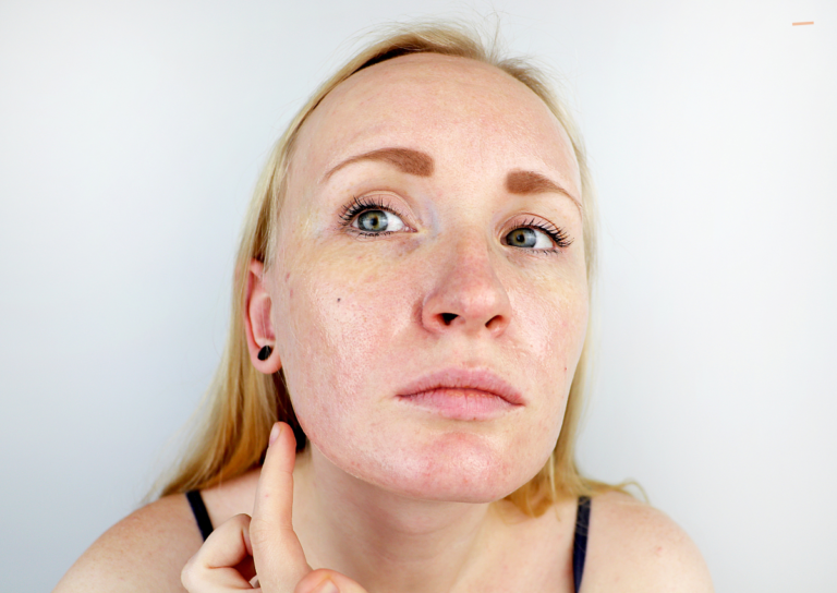 Skin Reset in Singapore: Clear Pigmentation Effectively